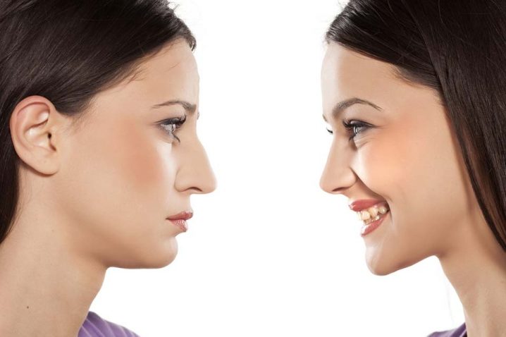 come cambia il viso con la rinoplastica