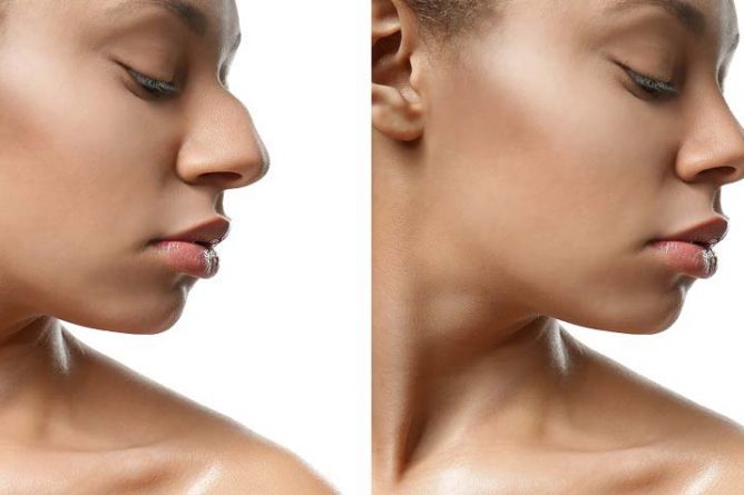 decorso post-operatorio di rinoplastica